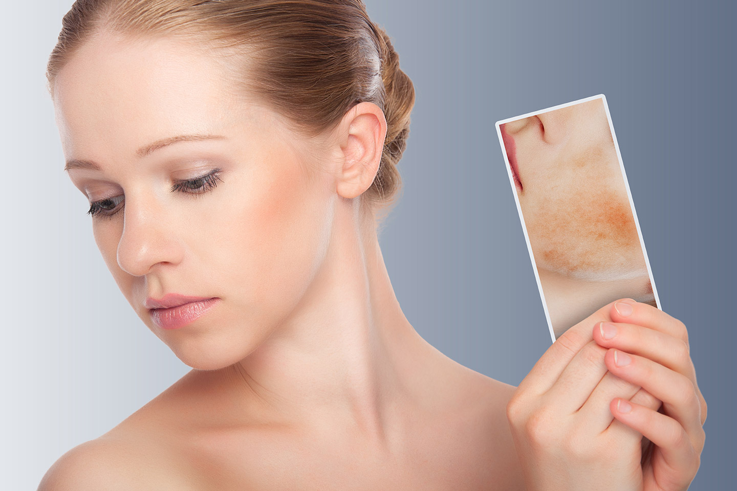 Acne Care