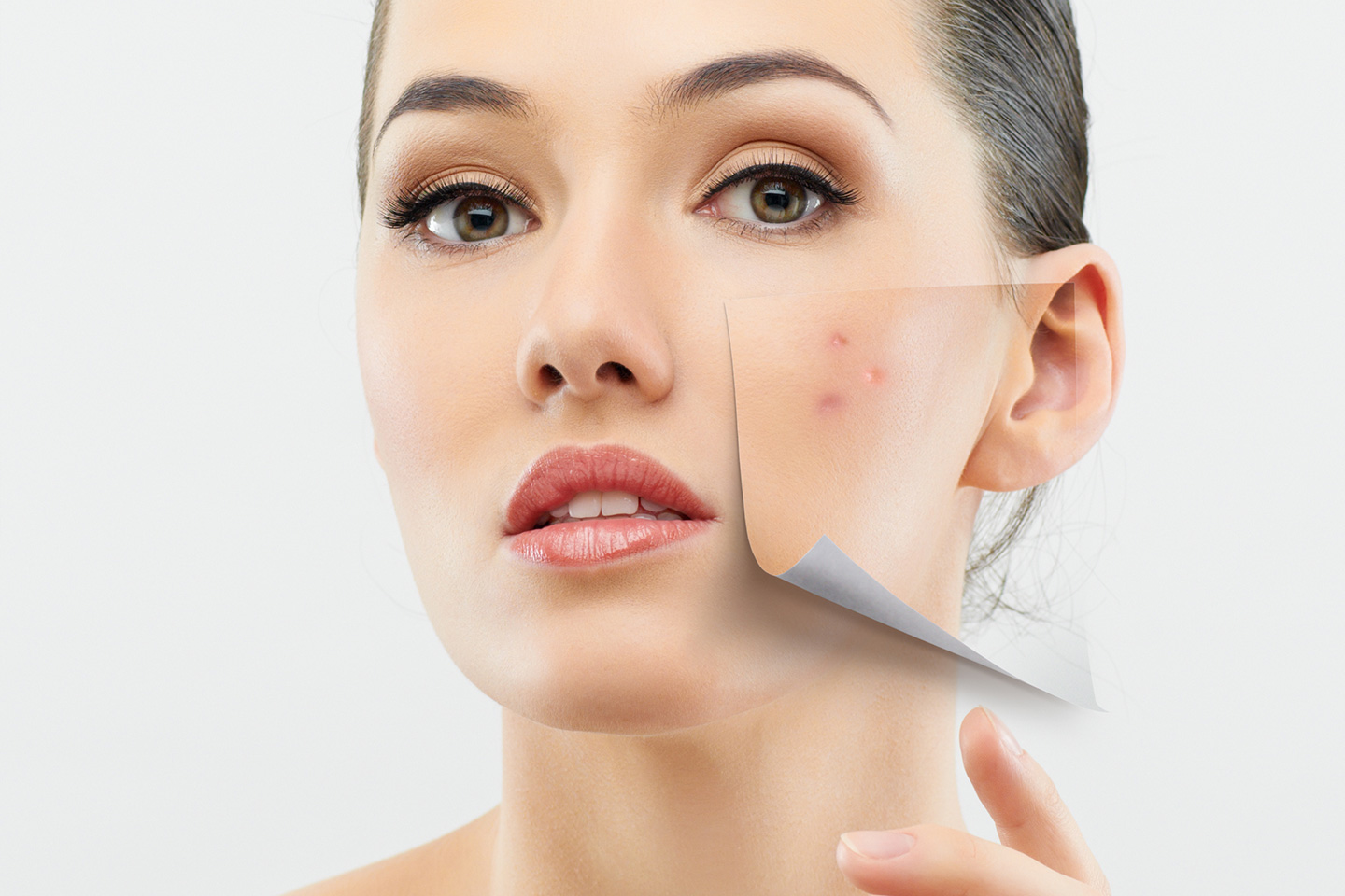 Matrix RF - Skin Resurfacing